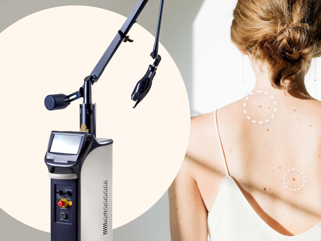 Pohled na laser Lutronic eCO2 a záda mladé ženy pokryté znaménky