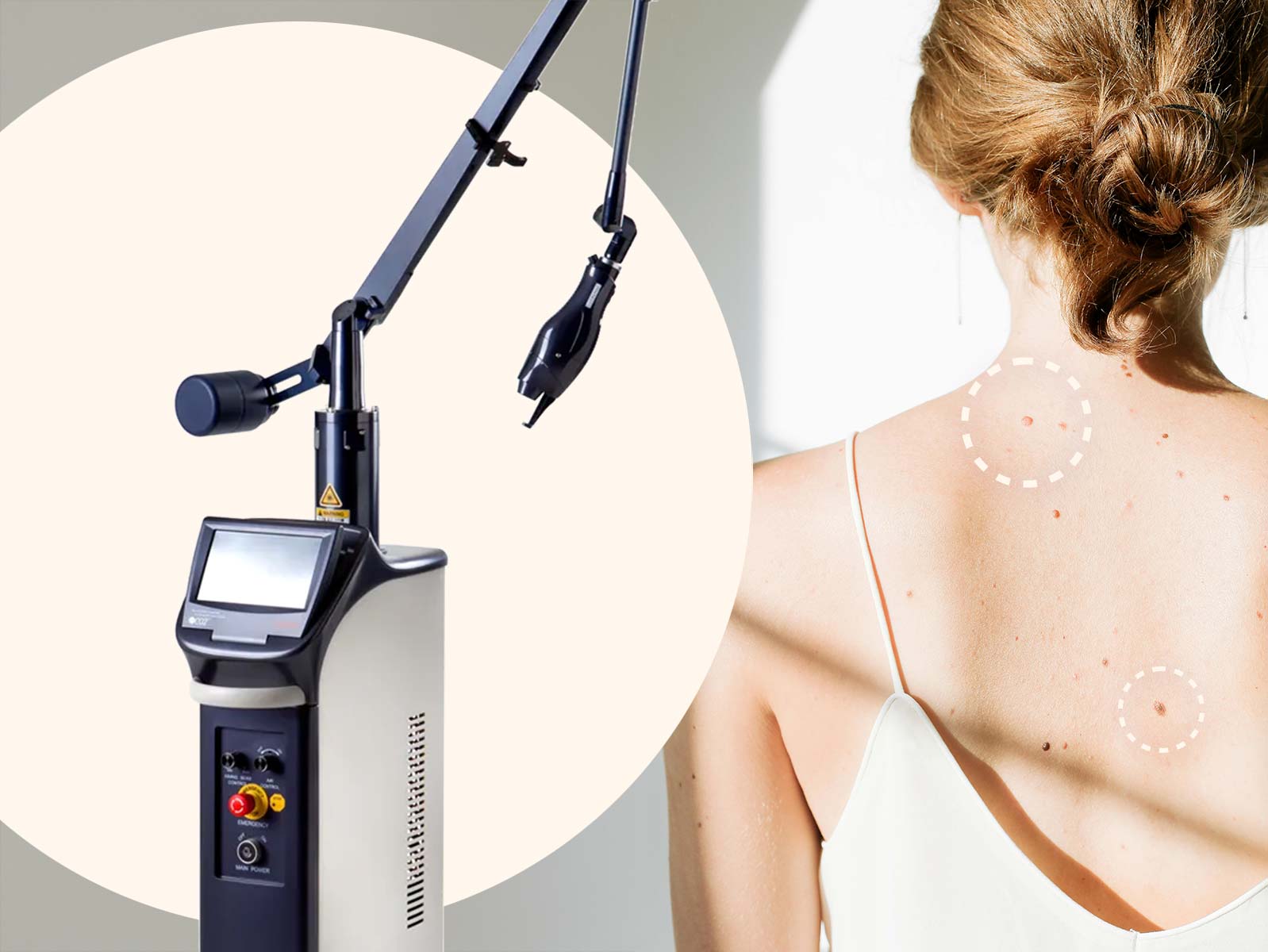 Pohled na laser Lutronic eCO2 a záda mladé ženy pokryté znaménky