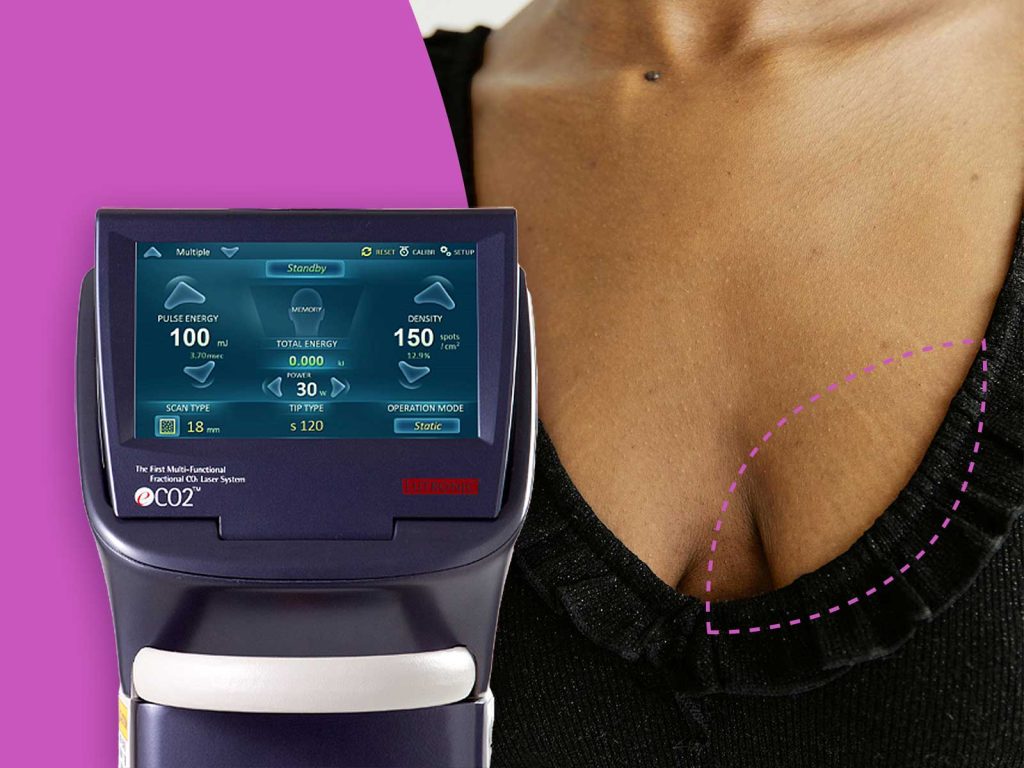 Pohled na laser Lutronic a dekolt se striemi